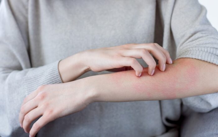 Itching Skin Allergies